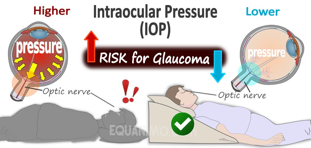 EZsleep Wedge Prevents High Introocularpressure (high eye pressure), hence reducing risks of damaging optic nerves