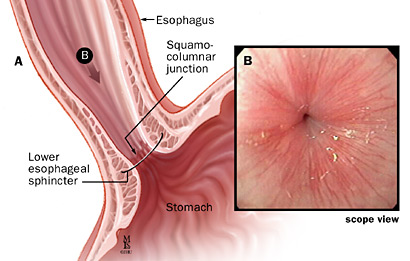 The lower esophageal sphincter