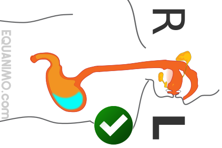 Schlafen auf der liken Seite ist GUT bei Reflux