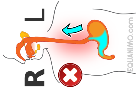 sleeping on the right side worsen the reflux symptom