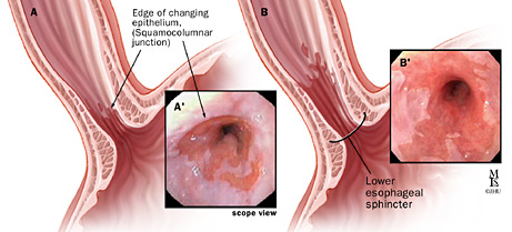 Short-segment and long-segment Barrett's esophagus