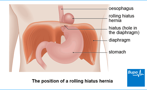Rolling hiatus hernia