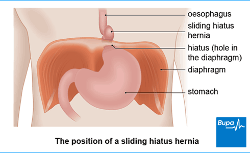 Sliding hiatus hernia
