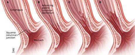 Normal Esophagus vs. Barrett's Esophagus